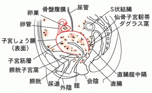 子宮内膜症と不妊　図①